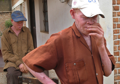 アルビノの6歳少女、殺害後に手足を切断され持ち去られる ブルンジ