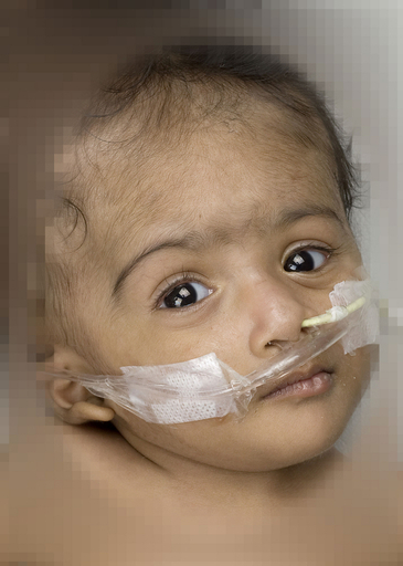 バングラデシュの1歳の結合双生児、豪病院で1回目の手術に成功