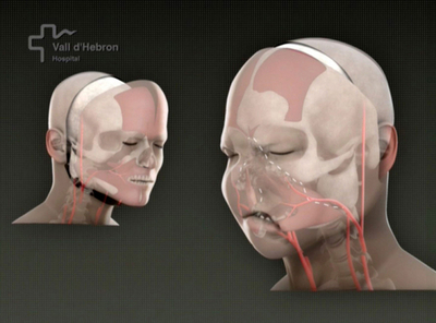 CGで見る世界初、全顔面移植の手順