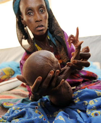 枯れ枝のような赤ちゃんの手足･･･サハラ砂漠南縁で深刻な飢餓