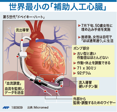 【図解】世界最小の「補助人工心臓」