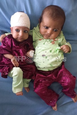 頭を2つ持つ赤ちゃんの頭部分離手術に成功 アフガニスタン 写真2枚 ファッション ニュースならmode Press Powered By Afpbb News