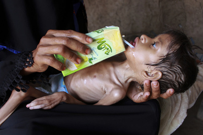 イエメンの子ども数百万人、「飢餓の瀬戸際」に？ コロナ禍で資金援助減