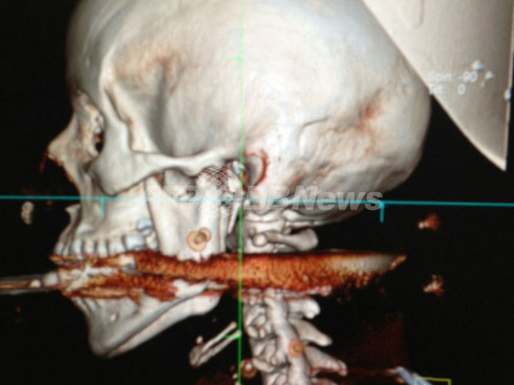 水中銃のもりがのどを貫通、奇跡的に一命取り留める ブラジル 水中銃のもりがのどを貫通、奇跡的に一命取り留める ブラジル