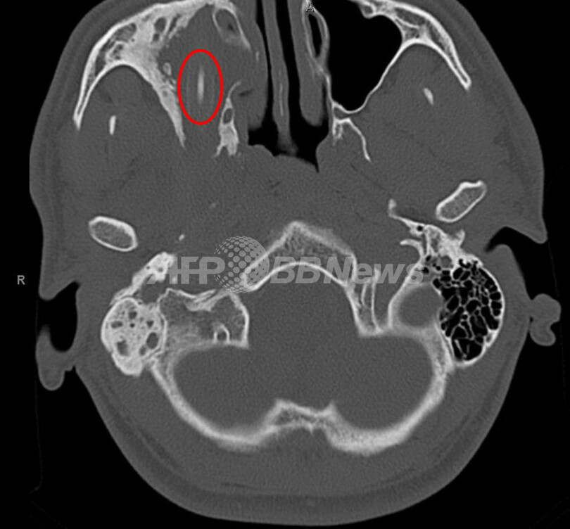 頭から鉛筆摘出、刺さったのは15年前？ドイツ