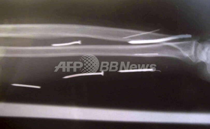 スリランカ人メイドの体内からクギ24本、サウジ雇用主の体罰か