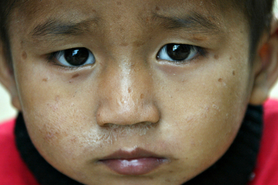 「黄金の三角地帯」に接するインド北東部、約10万人がHIV感染