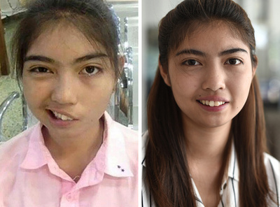 タイの女子高生、教師の暴力行為で顔面まひに 治療で笑顔を取り戻す