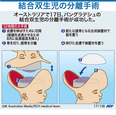 【図解】結合双生児の分離手術