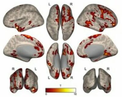 ADHDの子ども、脳機能が7～8歳で大きく変化…ソウル大病院チーム発表