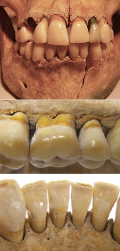 英国人の歯周炎、ローマ時代より現代の方が多い 研究