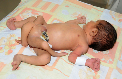 パキスタンで脚が6本ある赤ちゃん生まれる