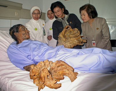 インドネシア保健相、「Tree Man」をめぐり米ディスカバリーチャンネルを激しく非難