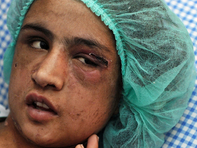 アフガニスタンの15歳妻、義父母からの「拷問」を証言