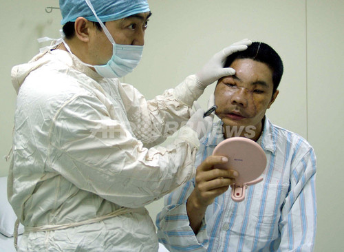 顔面移植手術を受けた中国人男性 今年7月に死亡 写真3枚 ファッション ニュースならmode Press Powered By Afpbb News