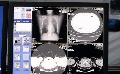 アリババ、新型肺炎の新たなAI診断技術を開発 正確度96% 中国