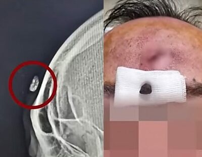 「額に1センチの石片、埋まったまま縫合」という痛さ…韓国・患者が医師の対応に怒り