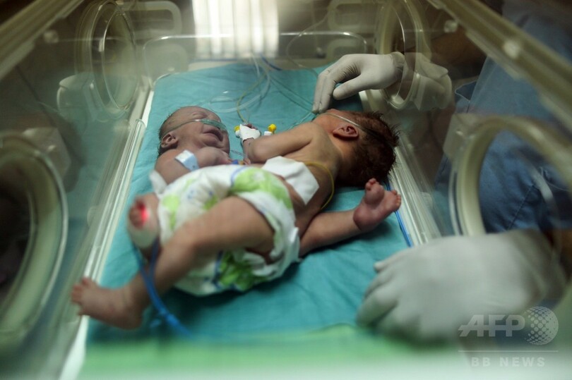 ガザ地区で結合双生児誕生、医師や親族が外国での分離手術訴え