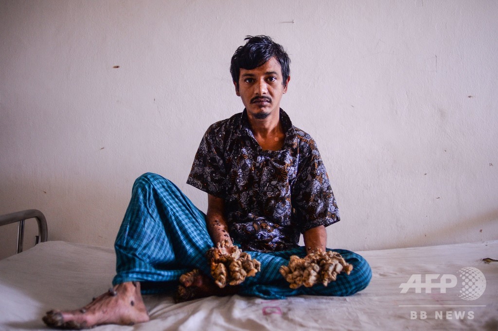 バングラデシュの 樹木男 両手切断を希望 耐え難い痛み訴え 写真5枚 国際ニュース Afpbb News