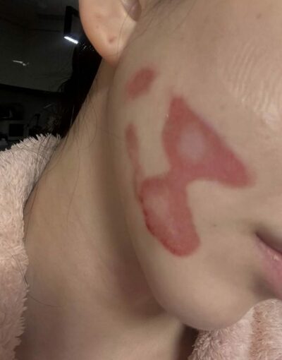 “きれいになりたかっただけなのに”…韓国女優、美容皮膚科施術で火傷被害