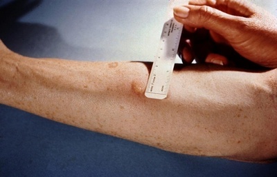 結核菌、初期人類を追ってアフリカから拡大 研究