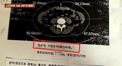 韓国の病院・検査結果欄に「豚の脂肪」はひどすぎる…抗議すると医師逆ギレ「二度と来るな」