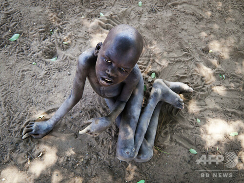 写真特集 世界各地で報告されている 難病 奇病 写真19枚 ファッション ニュースならmode Press Powered By Afpbb News