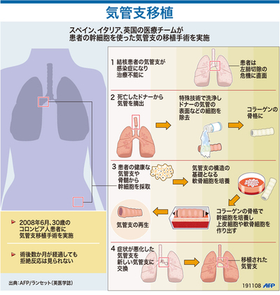 【図解】患者の幹細胞を使った気管支移植