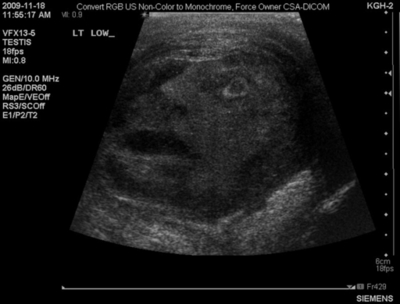 急患の睾丸腫瘍に「神の顔」、カナダの医師らが論文で発表