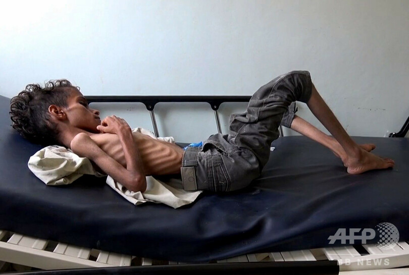 内戦下のイエメン 最大8万5000人の子どもが餓死 病死 写真3枚 国際ニュース Afpbb News