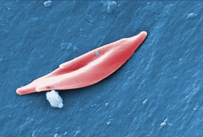 鎌状赤血球症、遺伝子治療で症状緩和に初成功 研究
