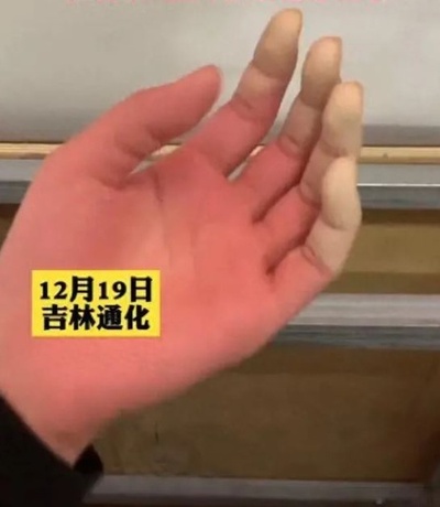 氷点下18度 中国東北部の女子生徒 手袋せずに凍傷で手の指切断の危機