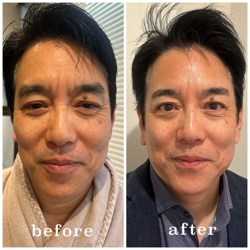 施術前（左）と施術後（右）の米村さん＝銀座メンズサロンMATHIS提供(c)KOREA WAVE