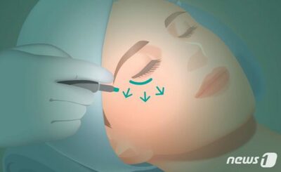 注射針が体の中で溶ける？「マイクロニードル」進化…韓国製薬業界に関心広がる