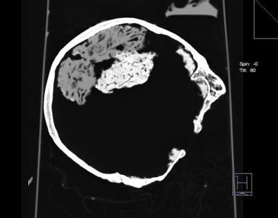 英国で鉄器時代の人間の脳見つかる