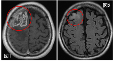 膠芽腫の画像起源の解明～いつから腫瘍は存在していたのか？～（北里大学）
