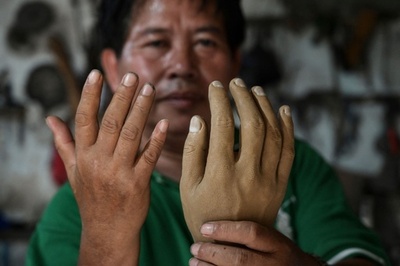 差別の痛みを糧に義肢製作 インドネシアのハンセン病元患者