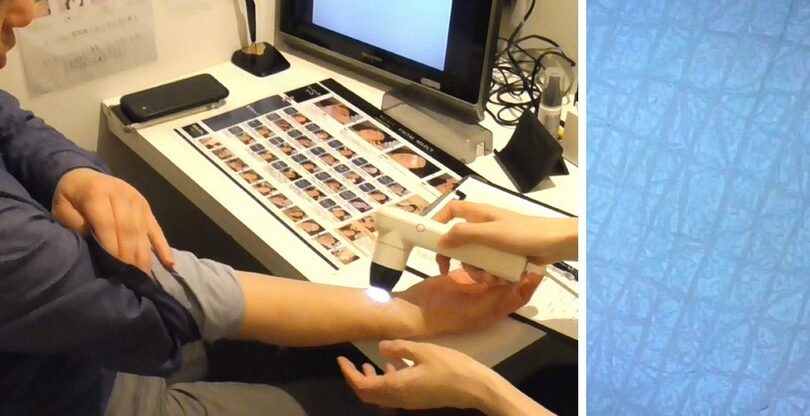 （左）米村さんの右手首の内側にマイクロスコープを当てられる（右）モニター画面に映し出された皮膚の表面。皮溝が網の目のように交差して皮丘を構成している(c)KOREA WAVE