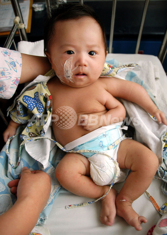 腕が3本ある赤ちゃん、除去手術を計画 - 中国 写真1枚 国際ニュース：AFPBB News