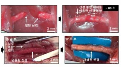 「切断された指の神経を1分で縫合」…“不思議なパッチ”を韓国研究チームが開発