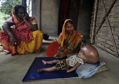 水頭症のルーナちゃん、「状態は良好も治療は複雑」 担当医師