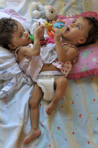 ブラジルの結合双生児、1歳の誕生日を迎える 分離手術は来年