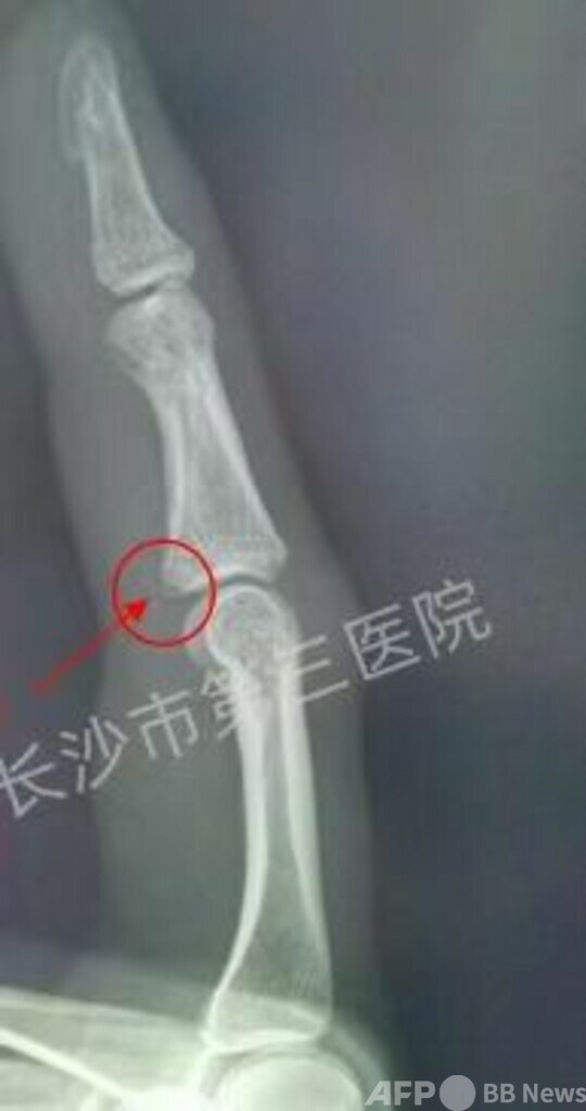 35歳の中国人女性 蚊をたたいてなんと骨折