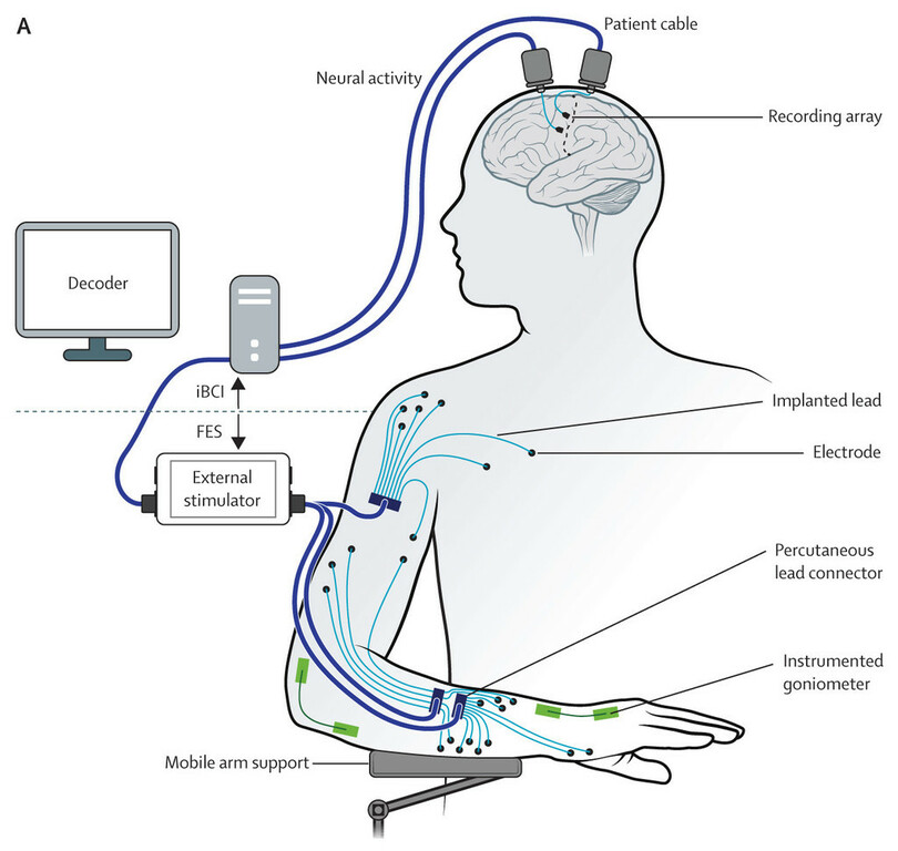 世界初 四肢まひ患者、脳に埋めた電極の信号で自ら食事 報告